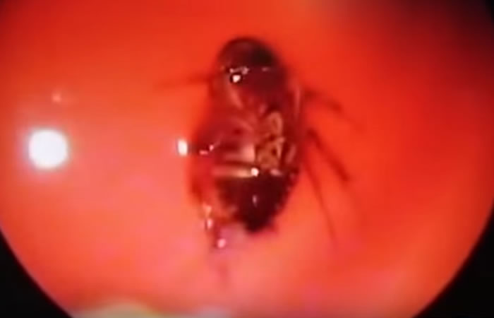Extraen cucaracha viva de la cabeza de una mujer. Foto: Youtube