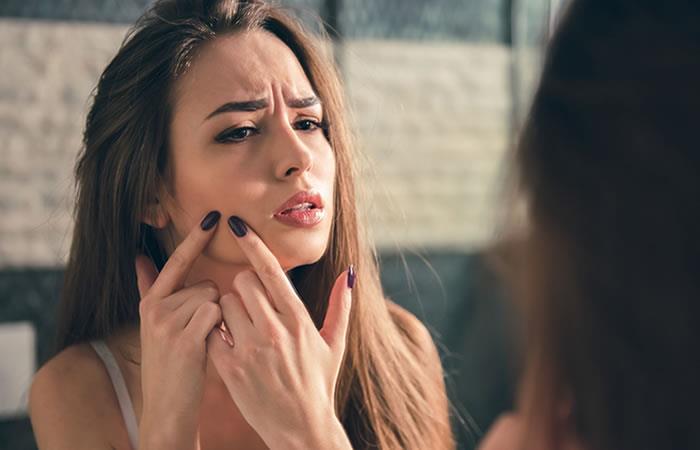 Trucos para eliminar el acné. Foto: Shutterstock