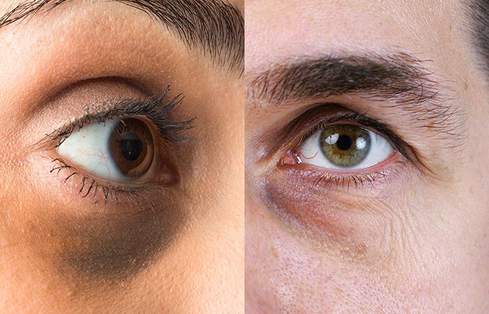 ¿Cómo eliminar las ojeras y la inflamación bajo los ojos?