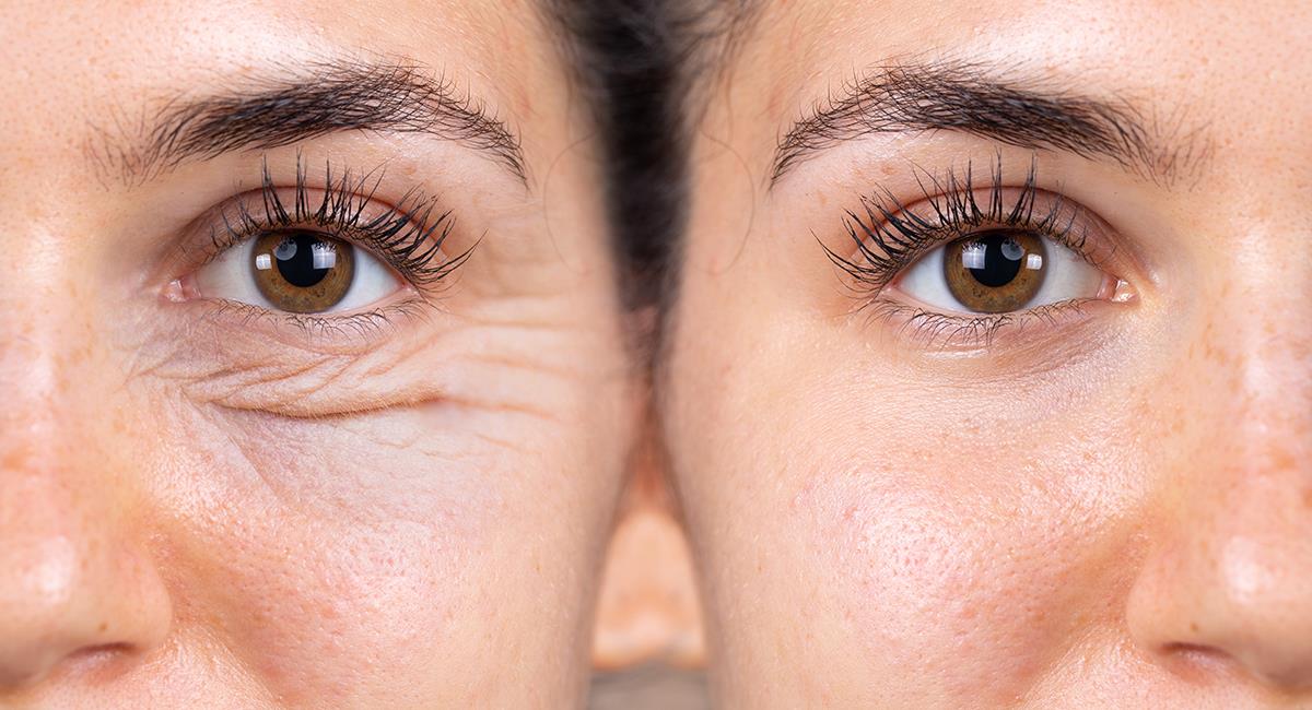 Trucos naturales para deshacerte de las ojeras y las bolsas en los ojos. Foto: Shutterstock
