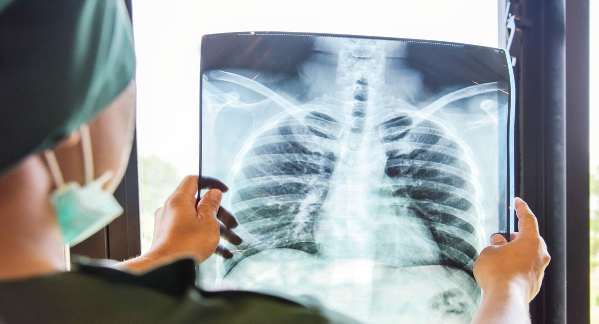 El cáncer de pulmón puede complicar una infección por COVID-19. Foto: Shutterstock