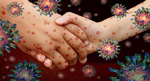 ONU: alerta por incremento en casos globales de sarampión