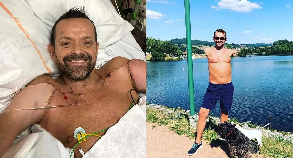 Felix es el primer humano del mundo en someterse a un trasplante doble de brazos y hombros. Foto: Instagram @felix_gretarsson