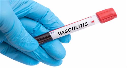 Vasculitis, la rara enfermedad por la que Ashton Kutcher casi pierde la vida